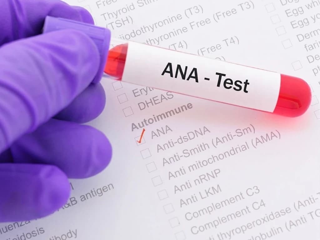 A gloved hand holding a blood sample tube labeled ANA Test over a lab request form with ANA checked